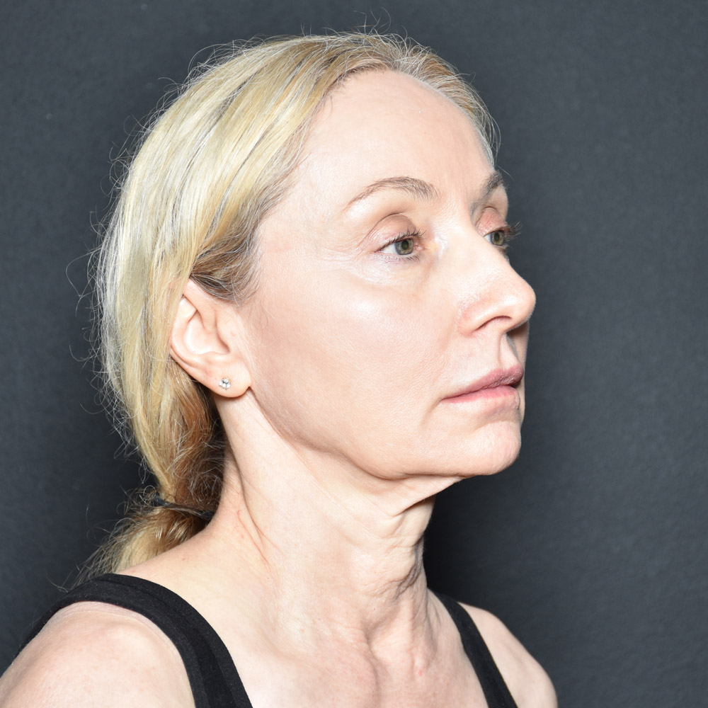 Case--3334 | Before Facelift and Neck Lift 5