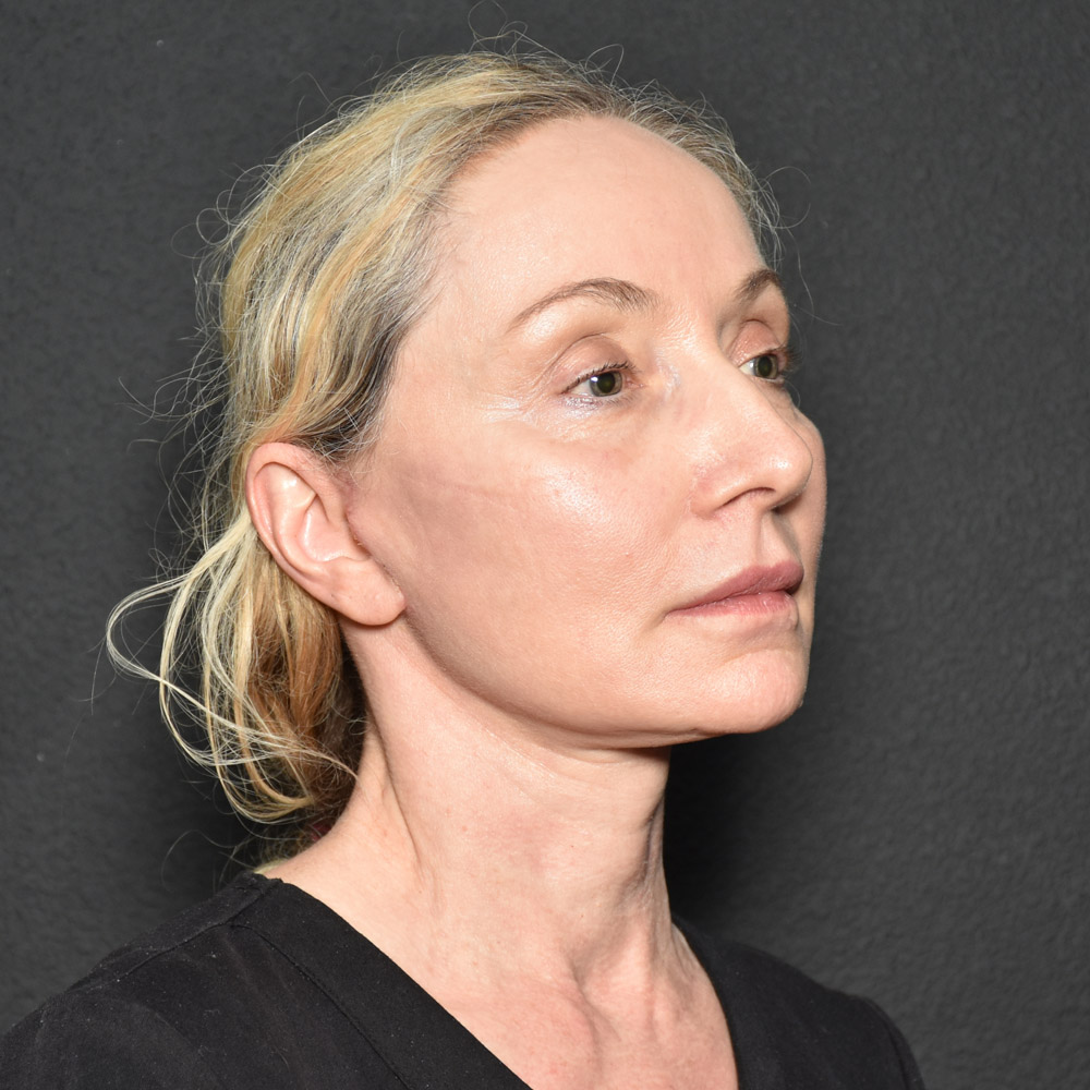 Case--3334 | After Facelift and Neck Lift 5