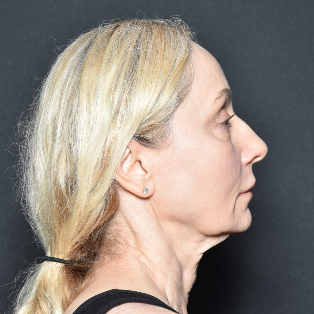 Case--3334 | Before Facelift and Neck Lift 4