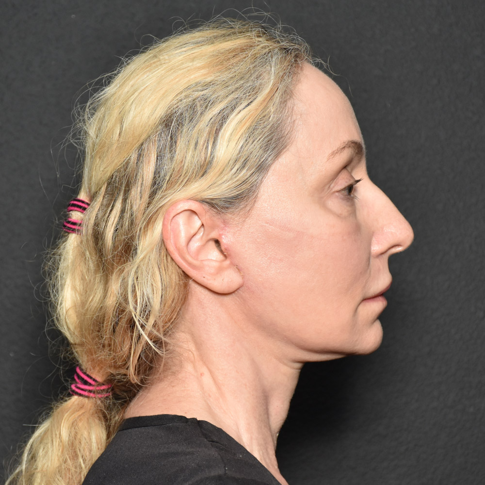 Case--3334 | After Facelift and Neck Lift 4