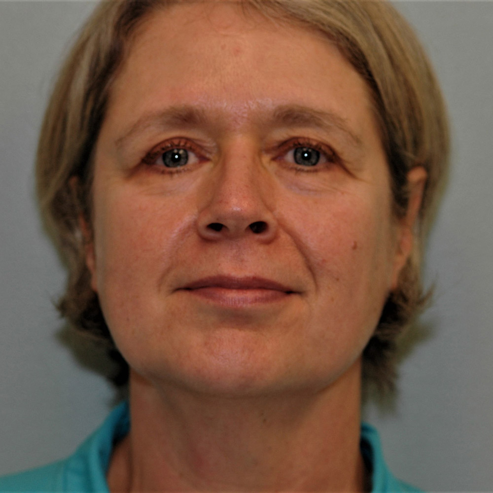 Case--3887 | Before Facelift and Neck Lift