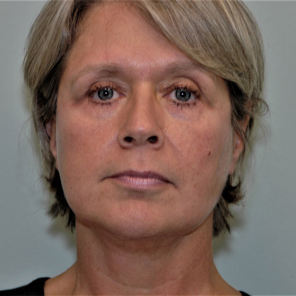 Case--3887 | After Facelift and Neck Lift