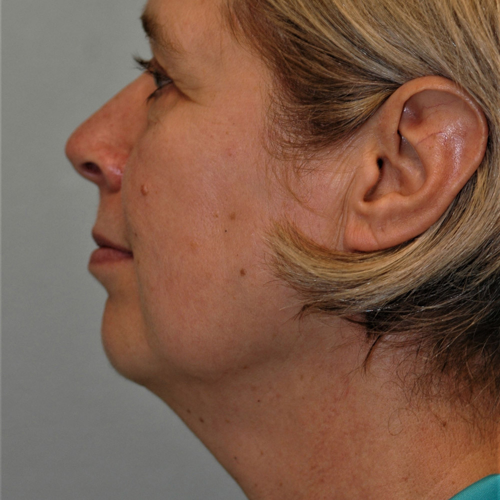 Case--3887 | Before Facelift and Neck Lift 2