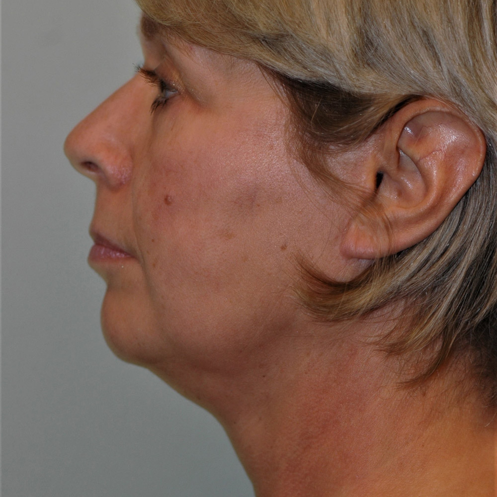 Case--3887 | After Facelift and Neck Lift 2