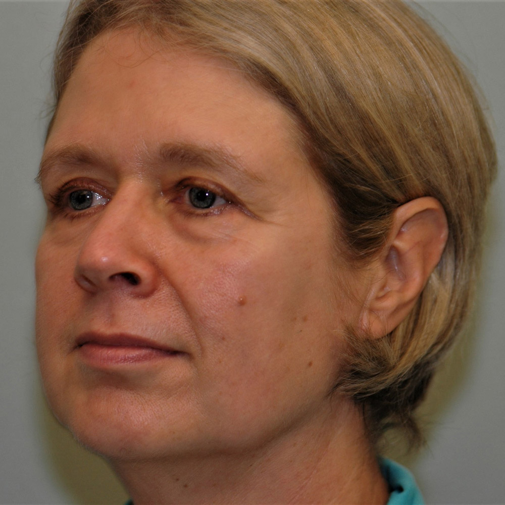 Case--3887 | Before Facelift and Neck Lift 3