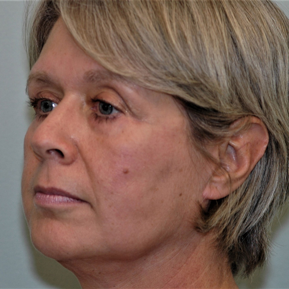 Case--3887 | After Facelift and Neck Lift 3