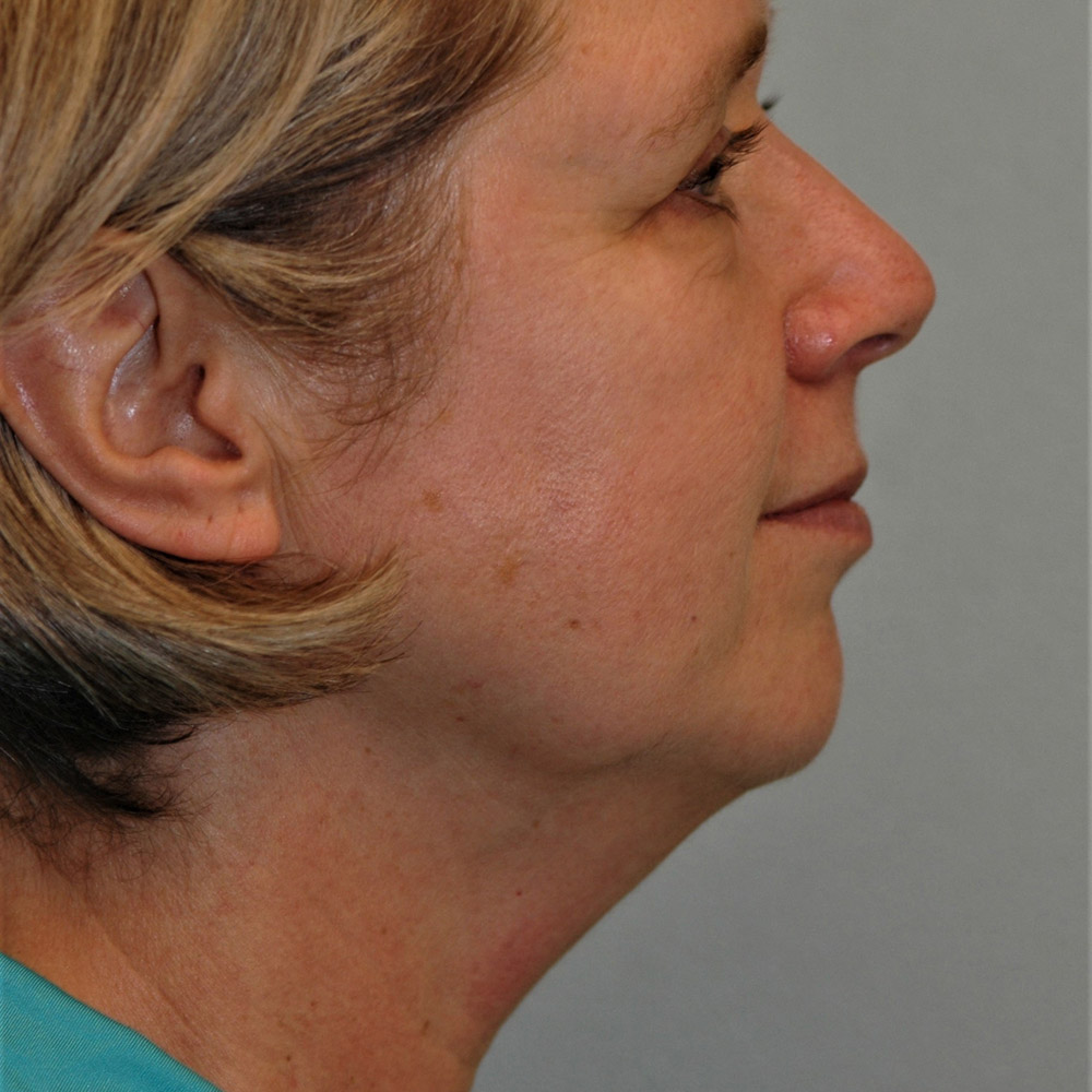 Case--3887 | Before Facelift and Neck Lift 4