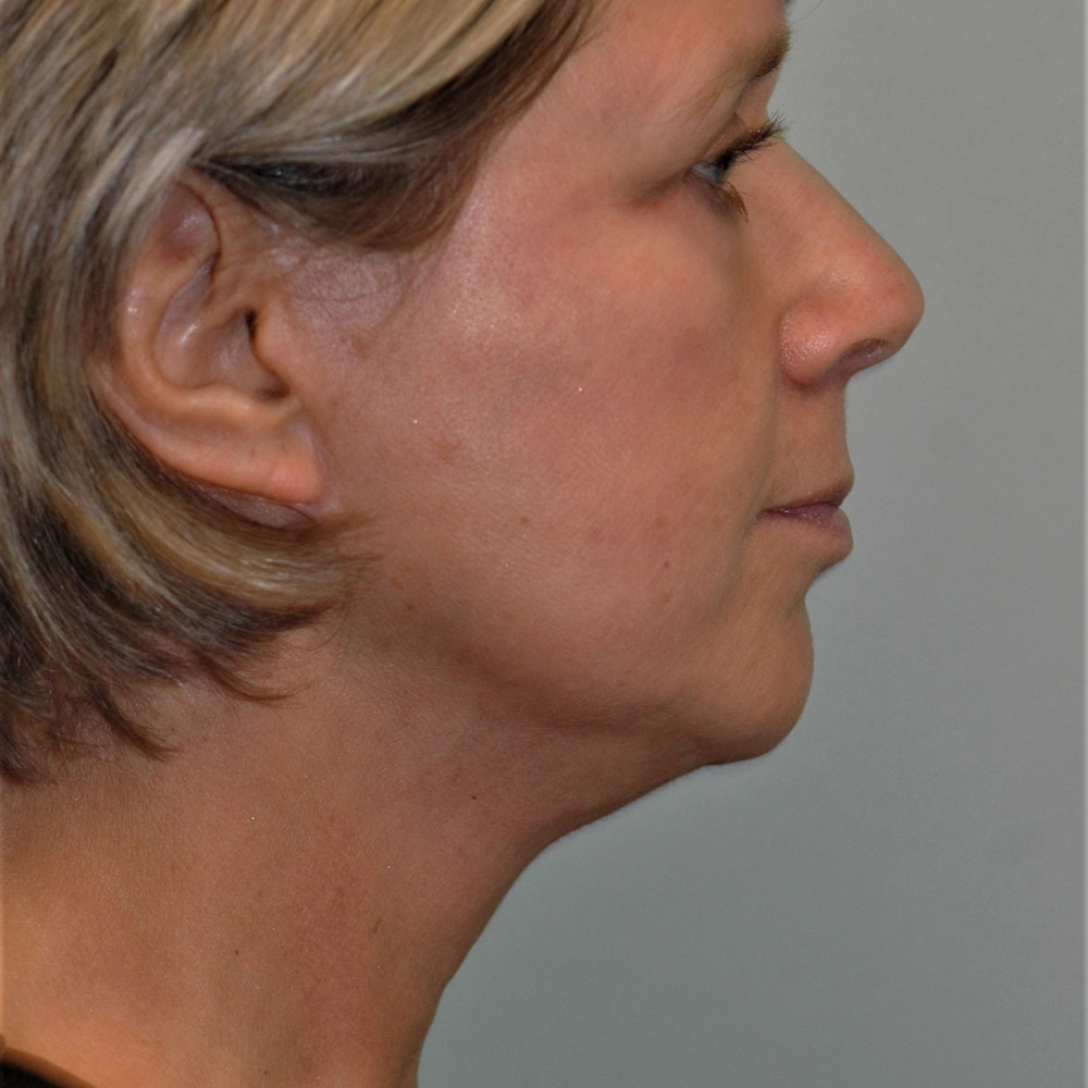 Case--3887 | After Facelift and Neck Lift 4