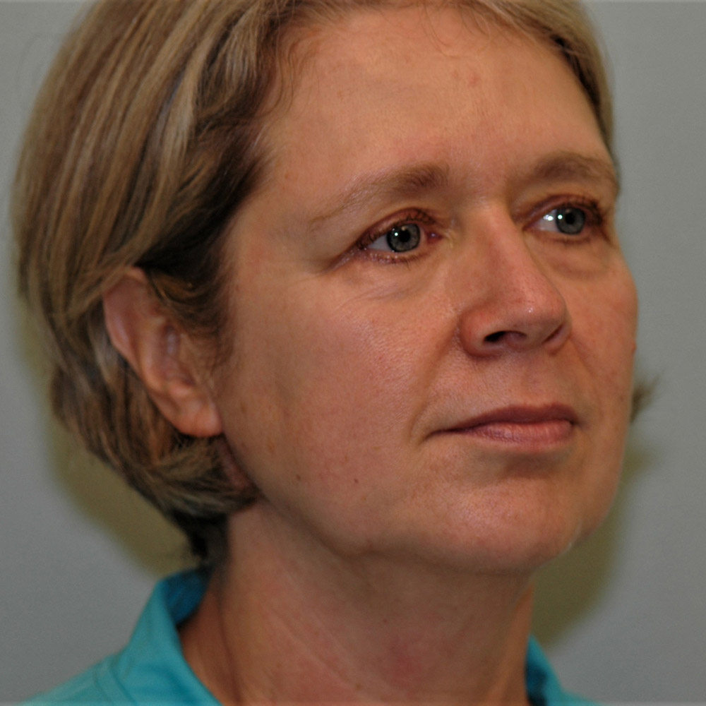 Case--3887 | Before Facelift and Neck Lift 5