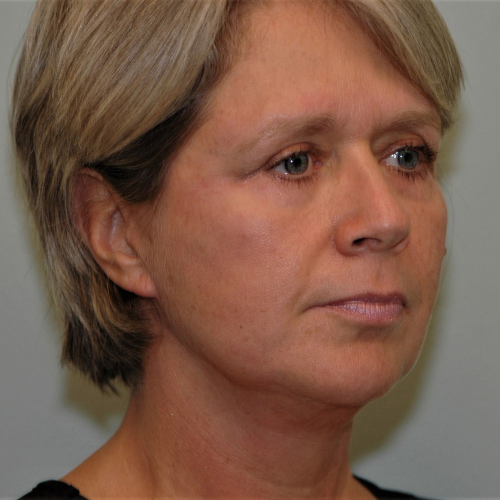 Case--3887 | After Facelift and Neck Lift 5