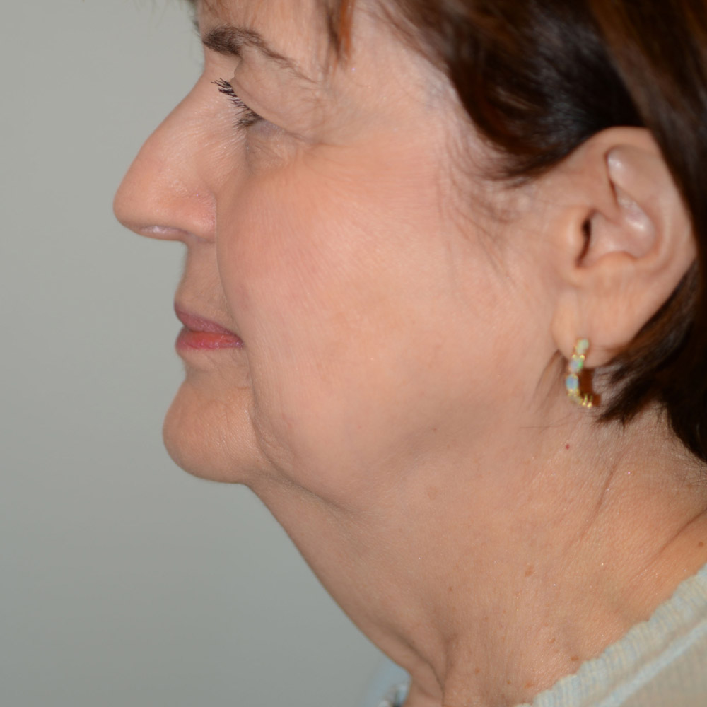 Case--6328 | Before Facelift and Neck Lift 2