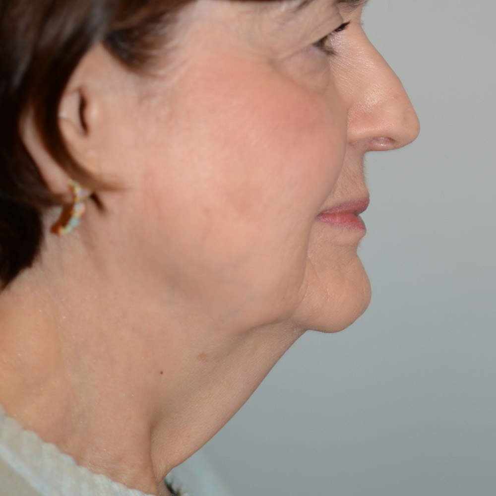 Case--6328 | Before Facelift and Neck Lift 3