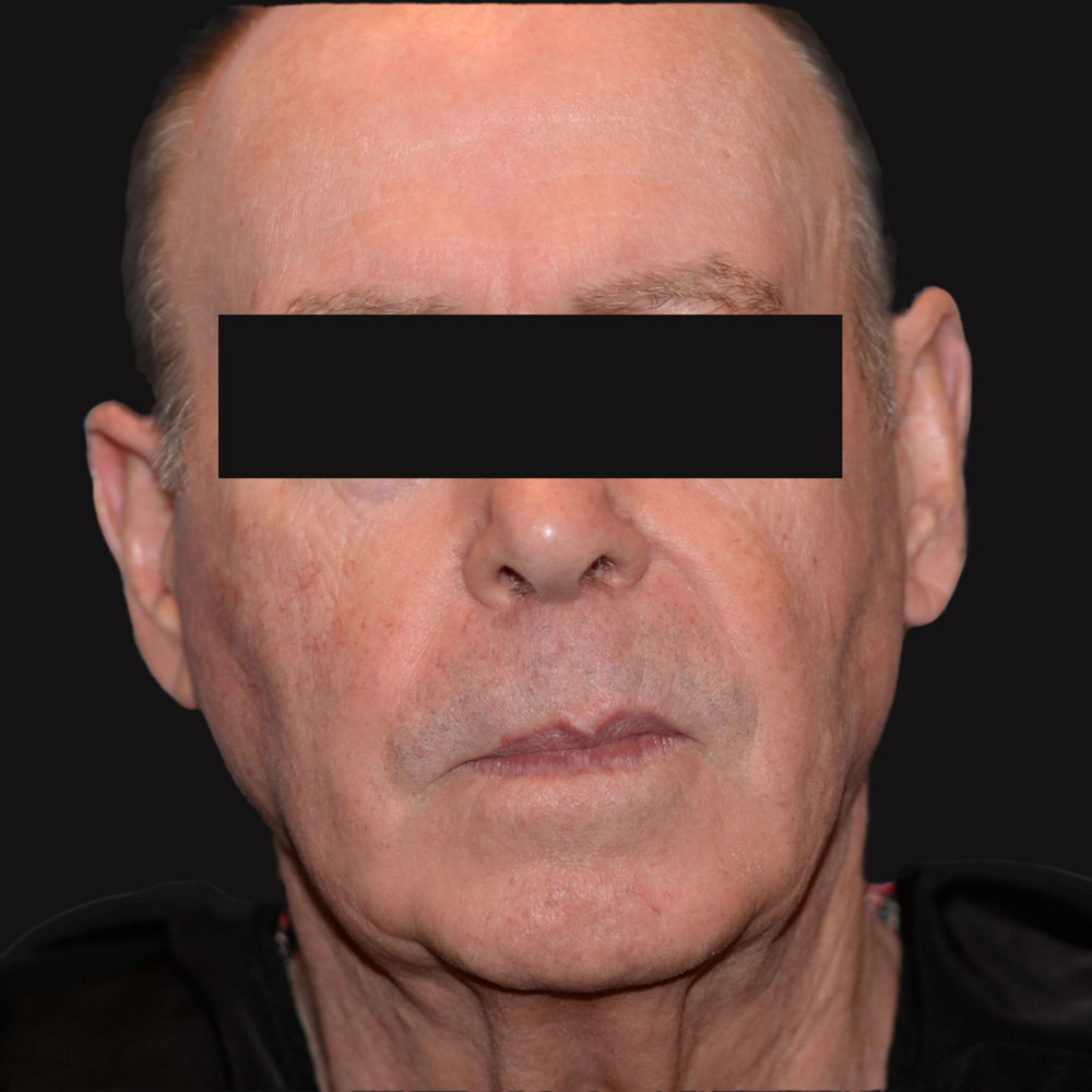 Case--6661 | Before Male Facelift