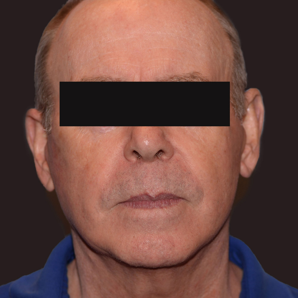Case--6661 | After Male Facelift
