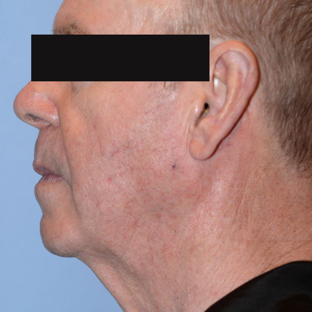 Case--2113 | Before Facelift and Neck Lift 2