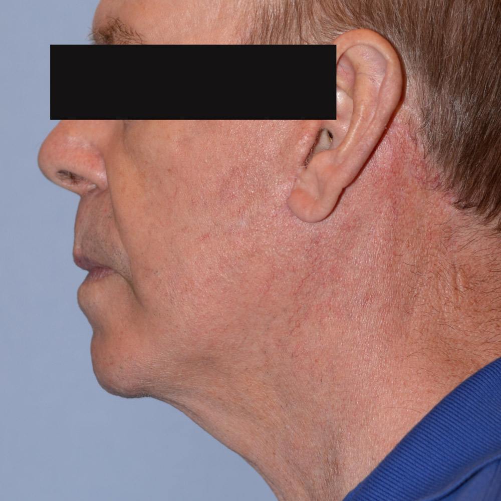 Case--2113 | After Facelift and Neck Lift 2