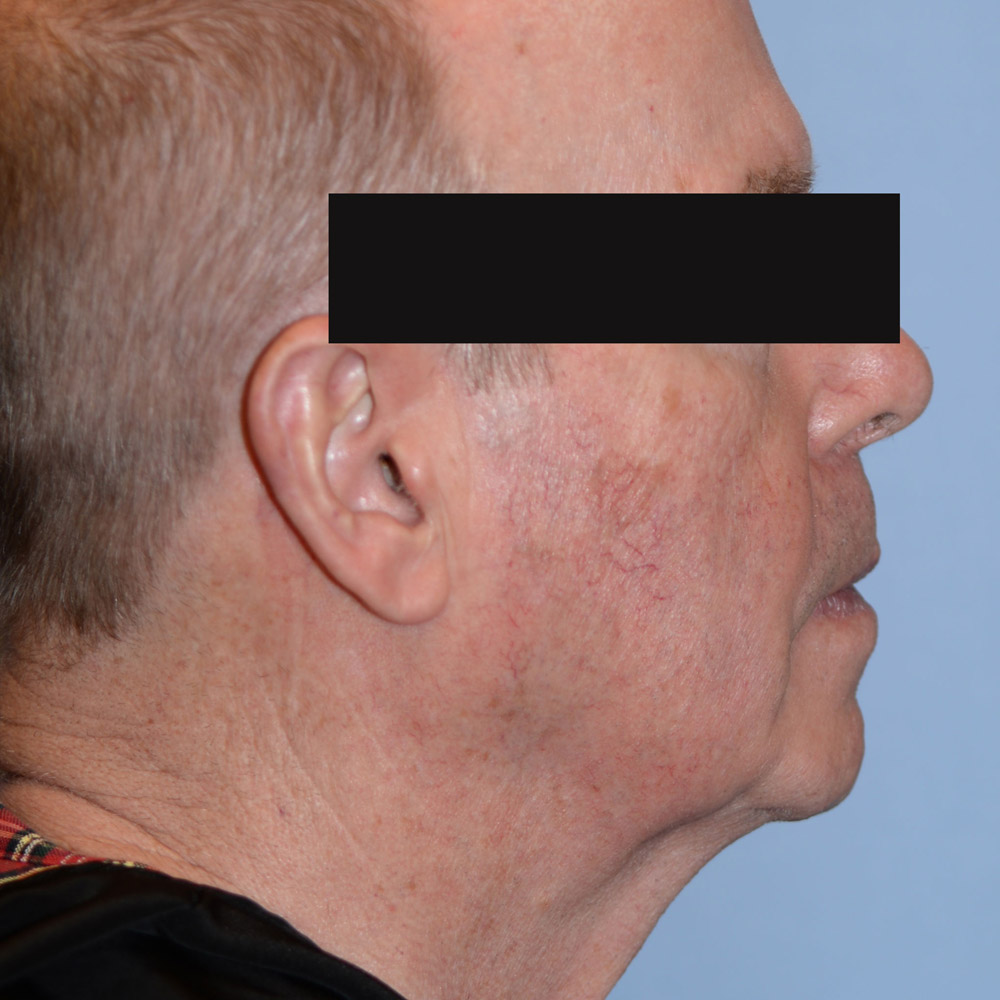 Case--2113 | Before Facelift and Neck Lift 3