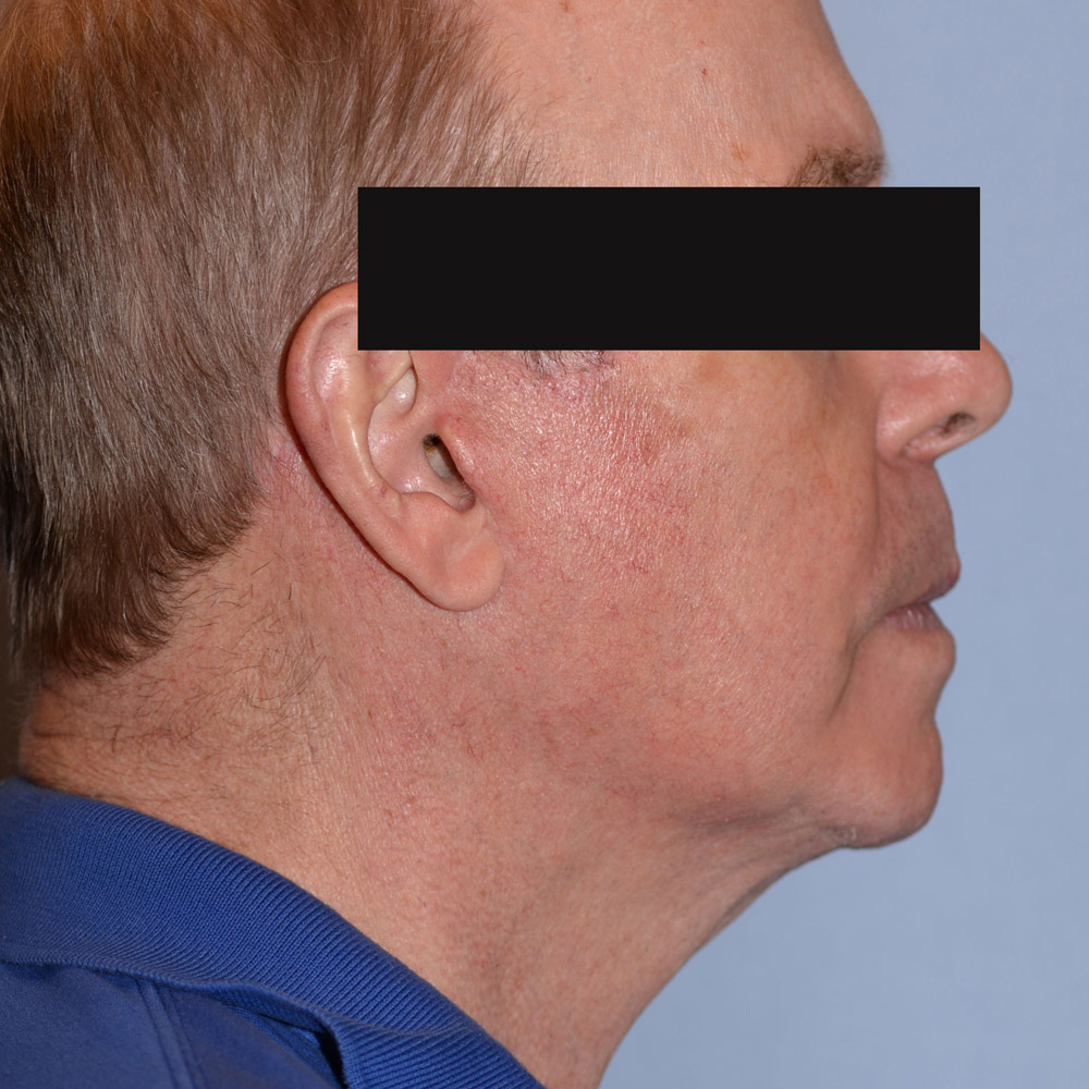 Case--2113 | After Facelift and Neck Lift 3