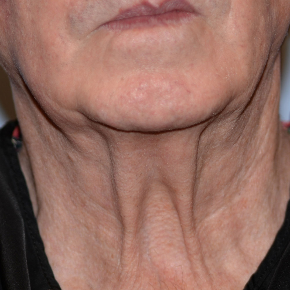 Case--2113 | Before Facelift and Neck Lift 4