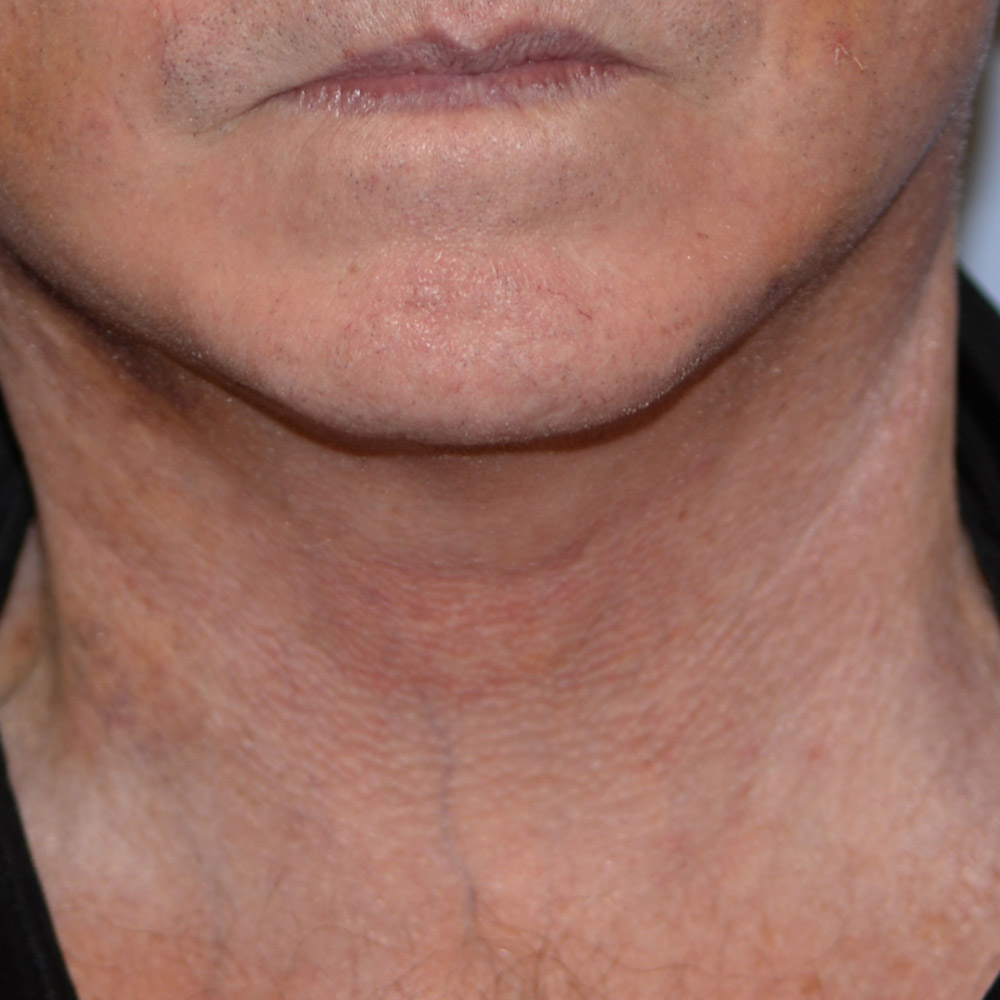 Case--2113 | After Facelift and Neck Lift 4