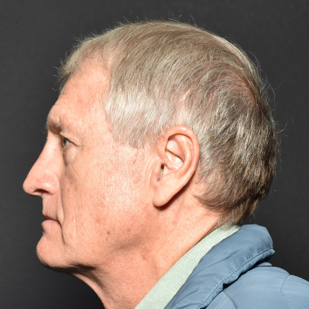 Case--8650 | Before Facelift and Neck Lift 5