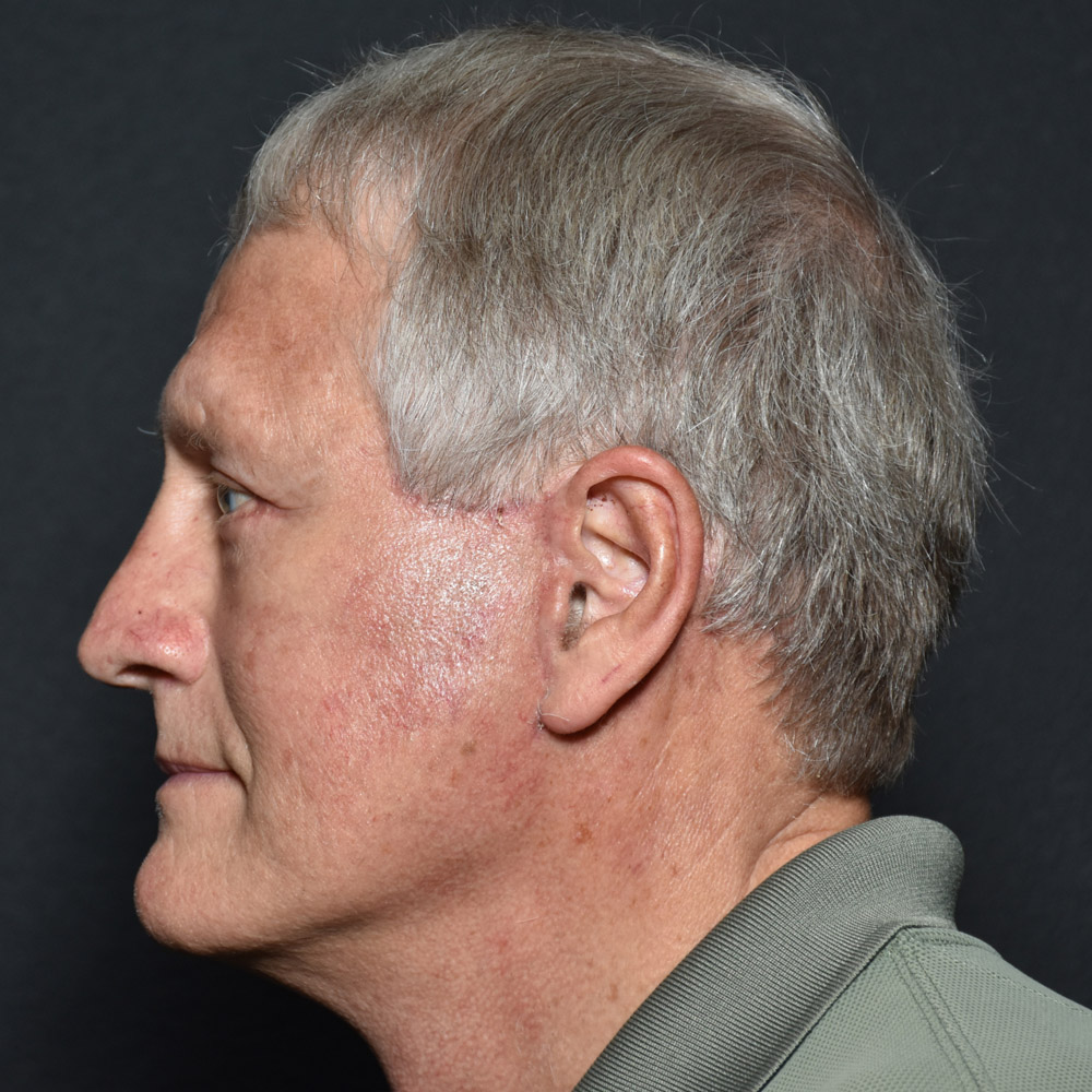 Case--8650 | After Facelift and Neck Lift 5