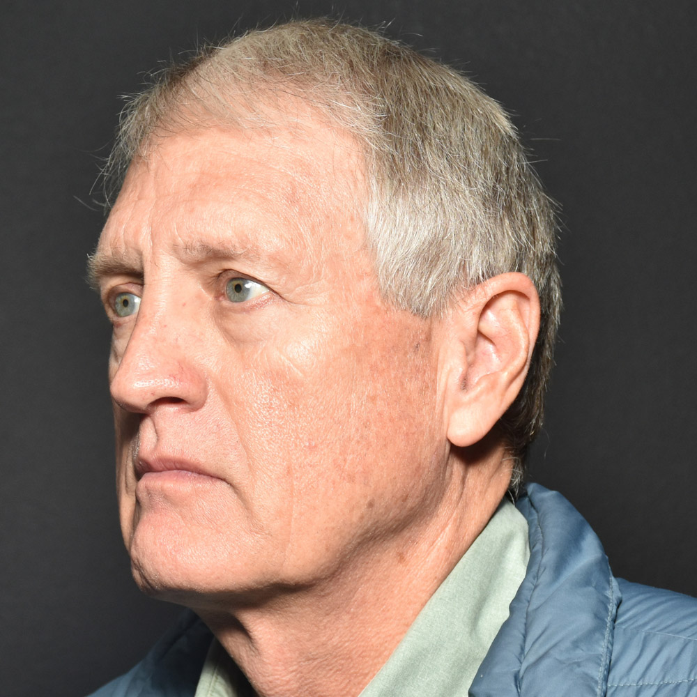 Case--8650 | Before Facelift and Neck Lift 4