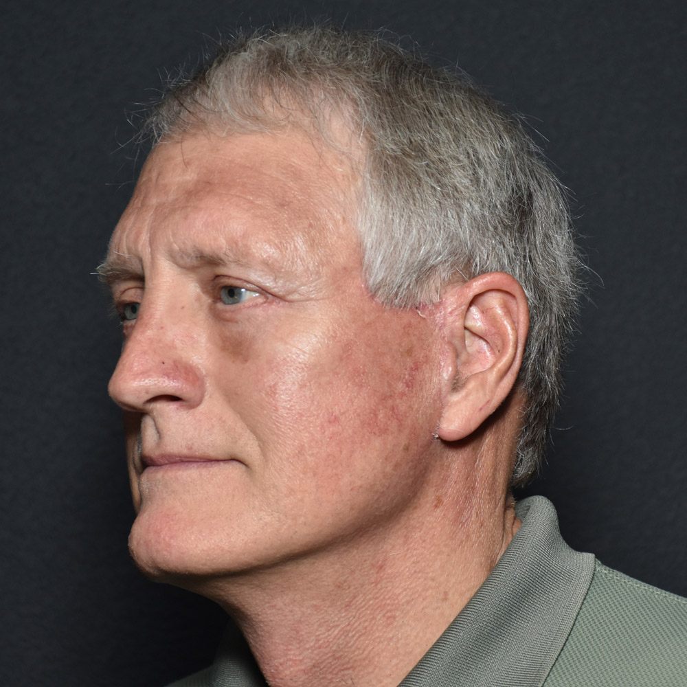 Case--8650 | After Facelift and Neck Lift 4