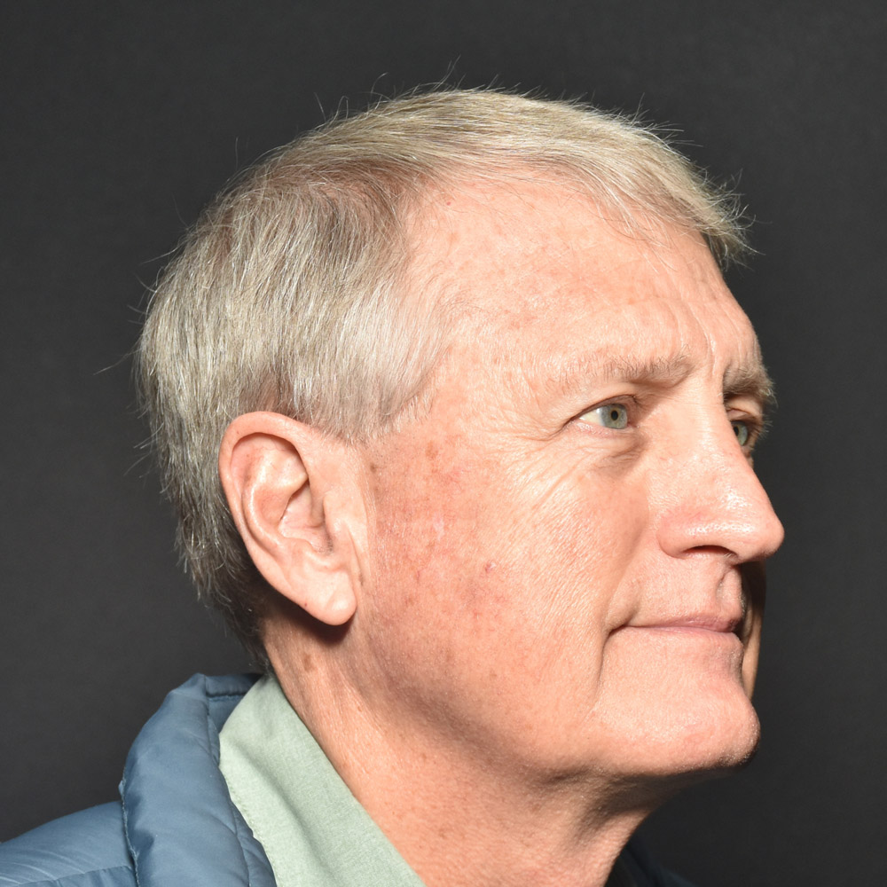 Case--8650 | Before Facelift and Neck Lift 2