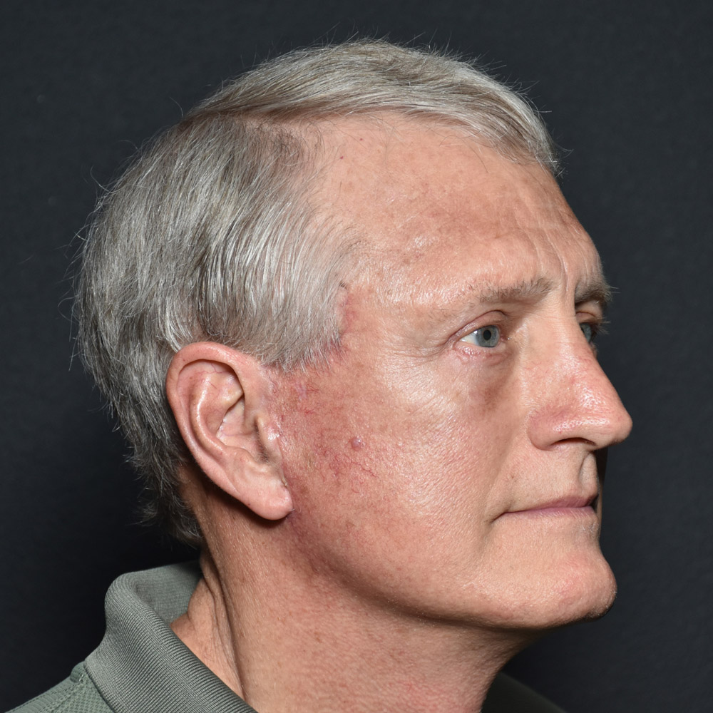 Case--8650 | After Facelift and Neck Lift 2