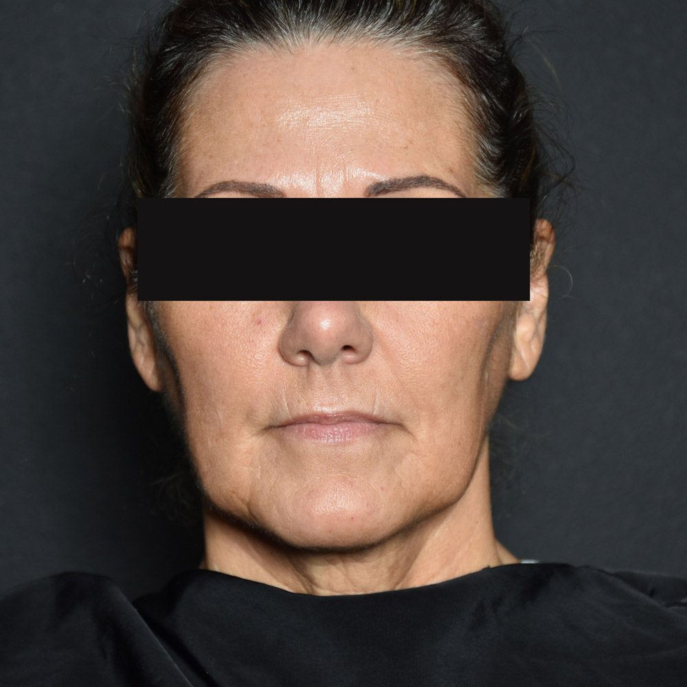 Case--8030 | Before Facelift and Neck Lift