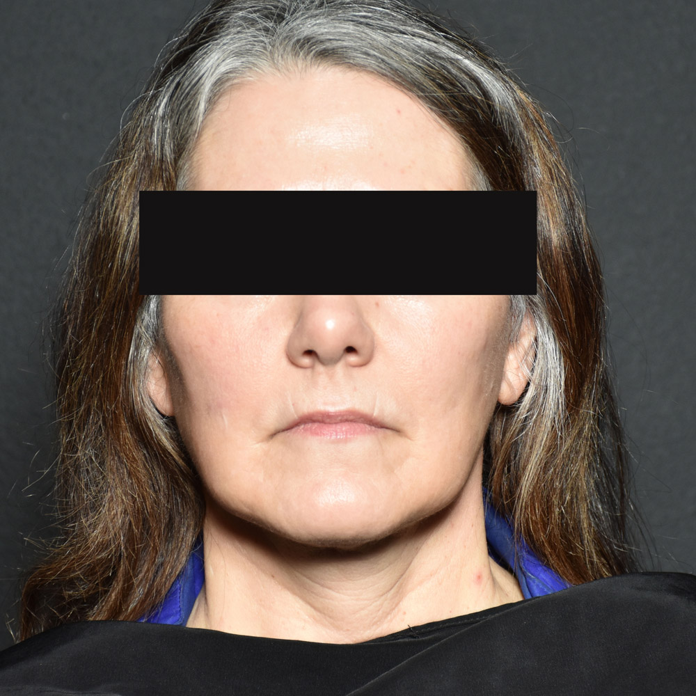 Case--8030 | After Facelift and Neck Lift