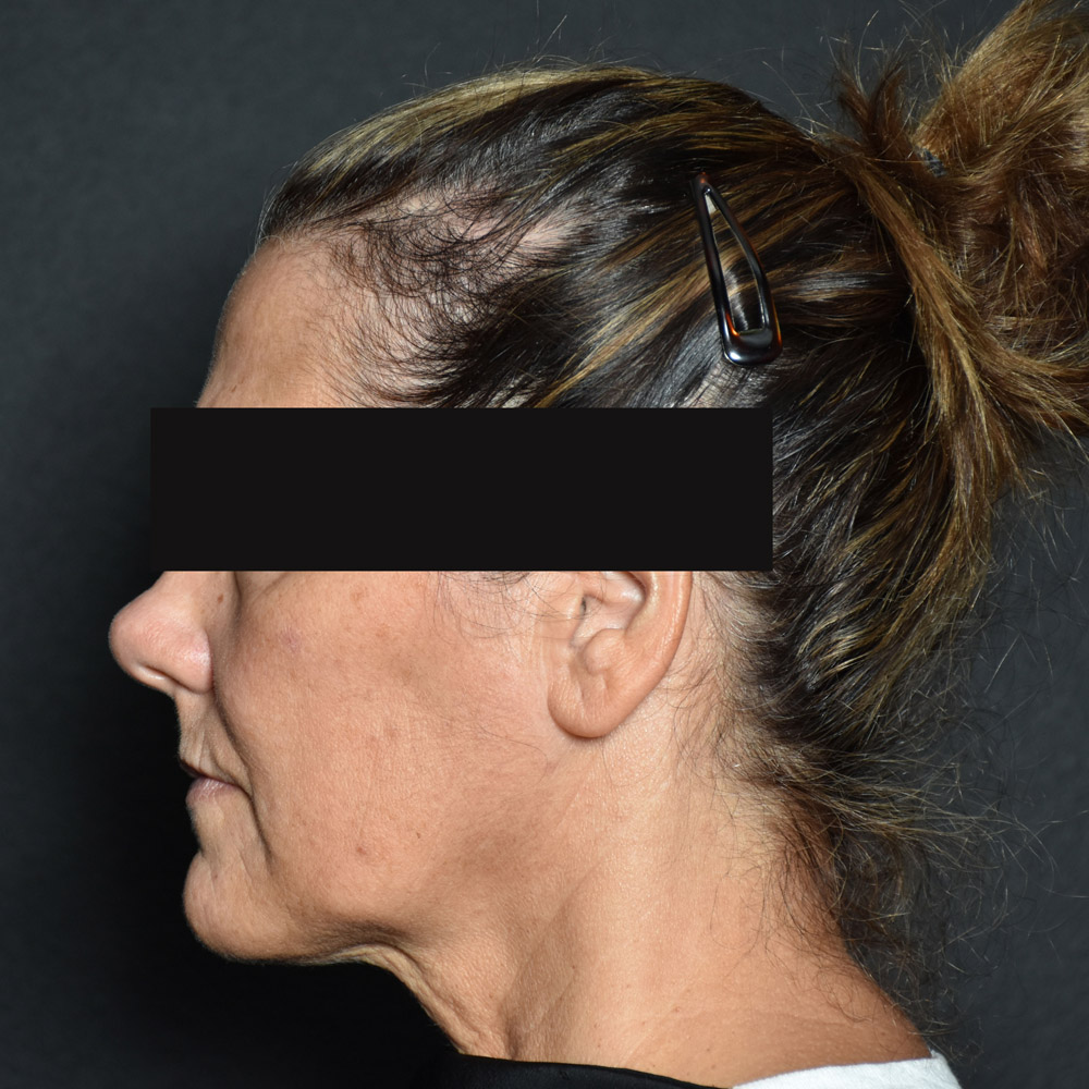 Case--8030 | Before Facelift and Neck Lift 2
