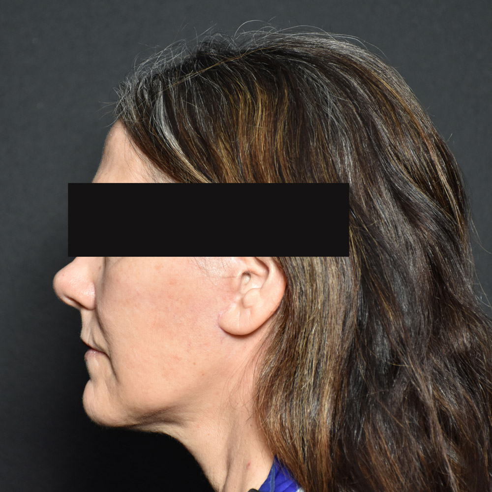 Case--8030 | After Facelift and Neck Lift 2