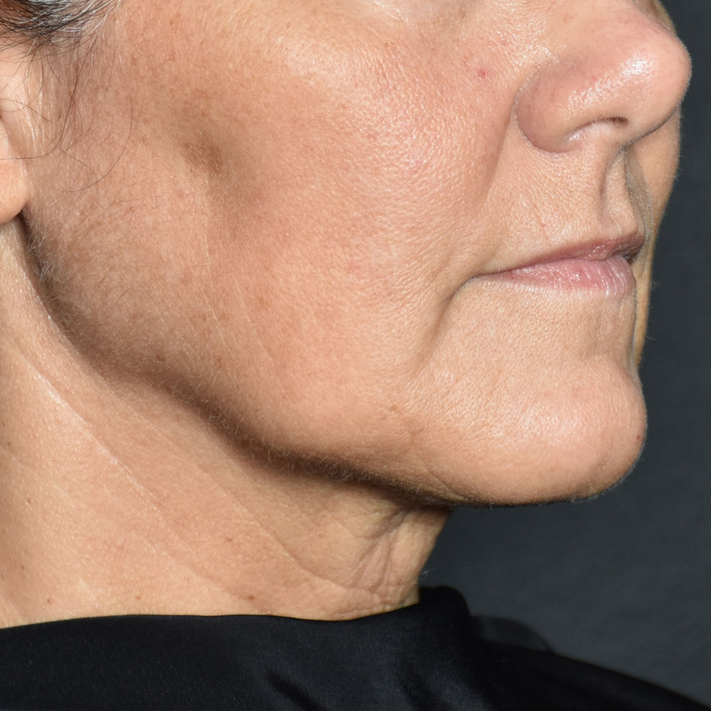 Case--8030 | Before Facelift and Neck Lift 3