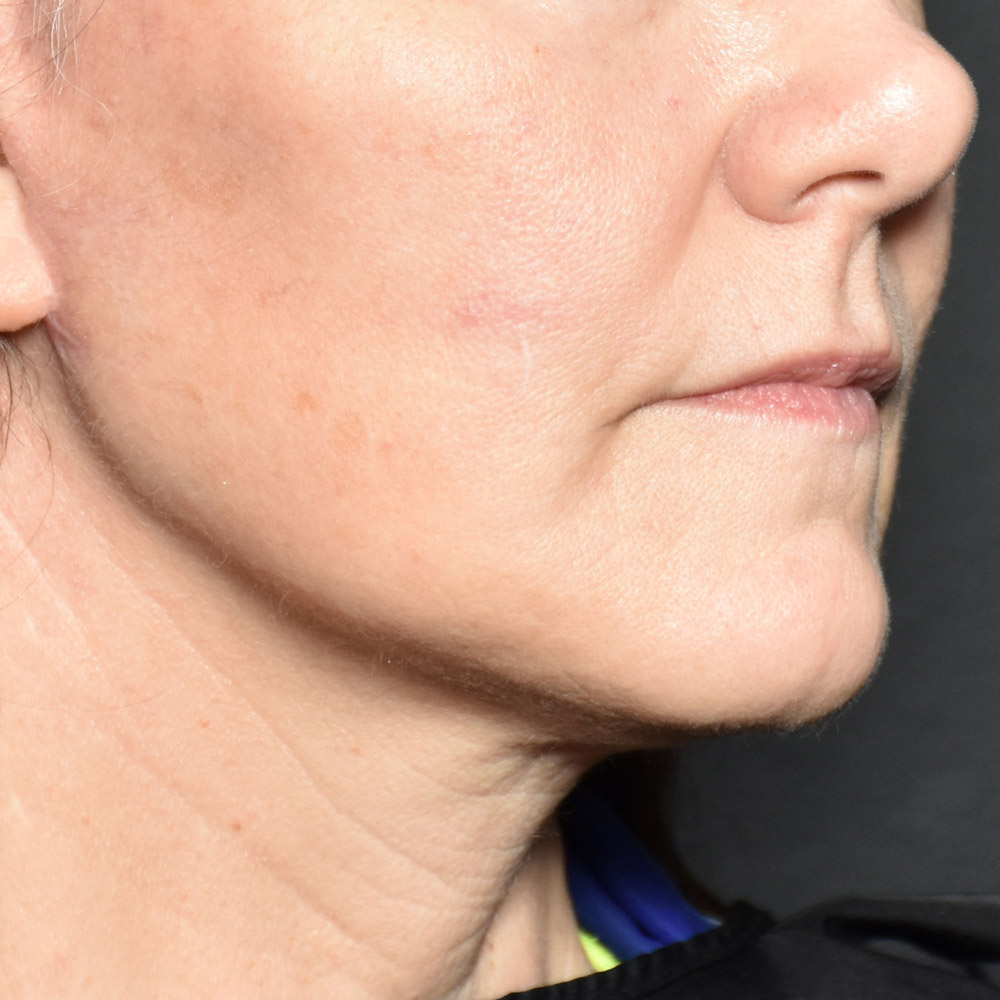 Case--8693 | After Facelift and Neck Lift 3