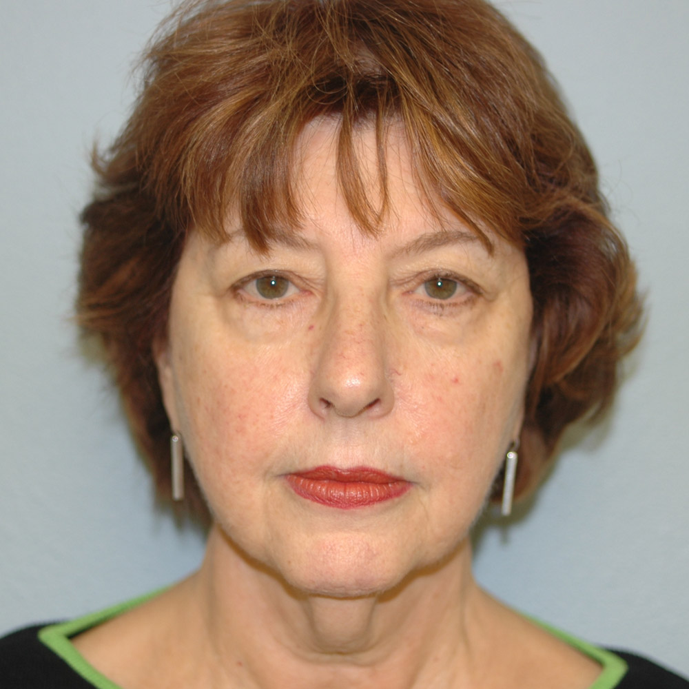 Case--8693 | Before Facelift and Neck Lift