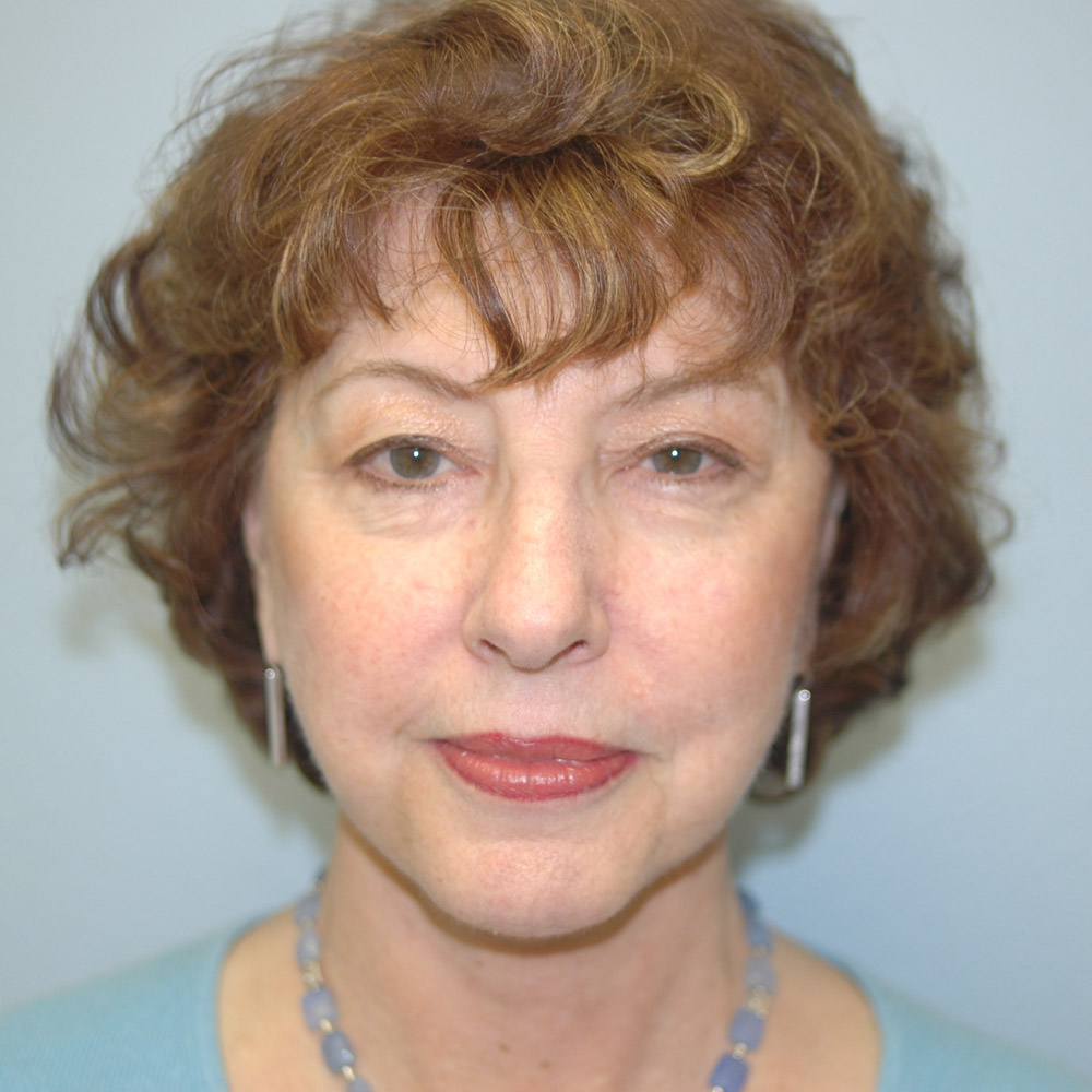 Case--8693 | After Facelift and Neck Lift