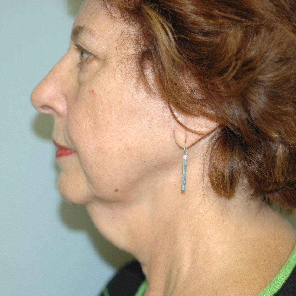 Case--8693 | Before Facelift and Neck Lift 2