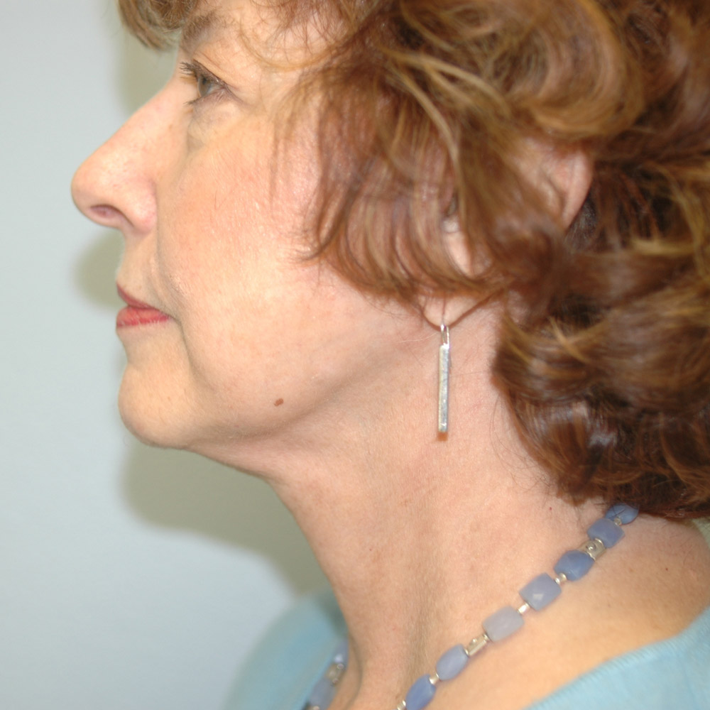 Case--8693 | After Facelift and Neck Lift 2
