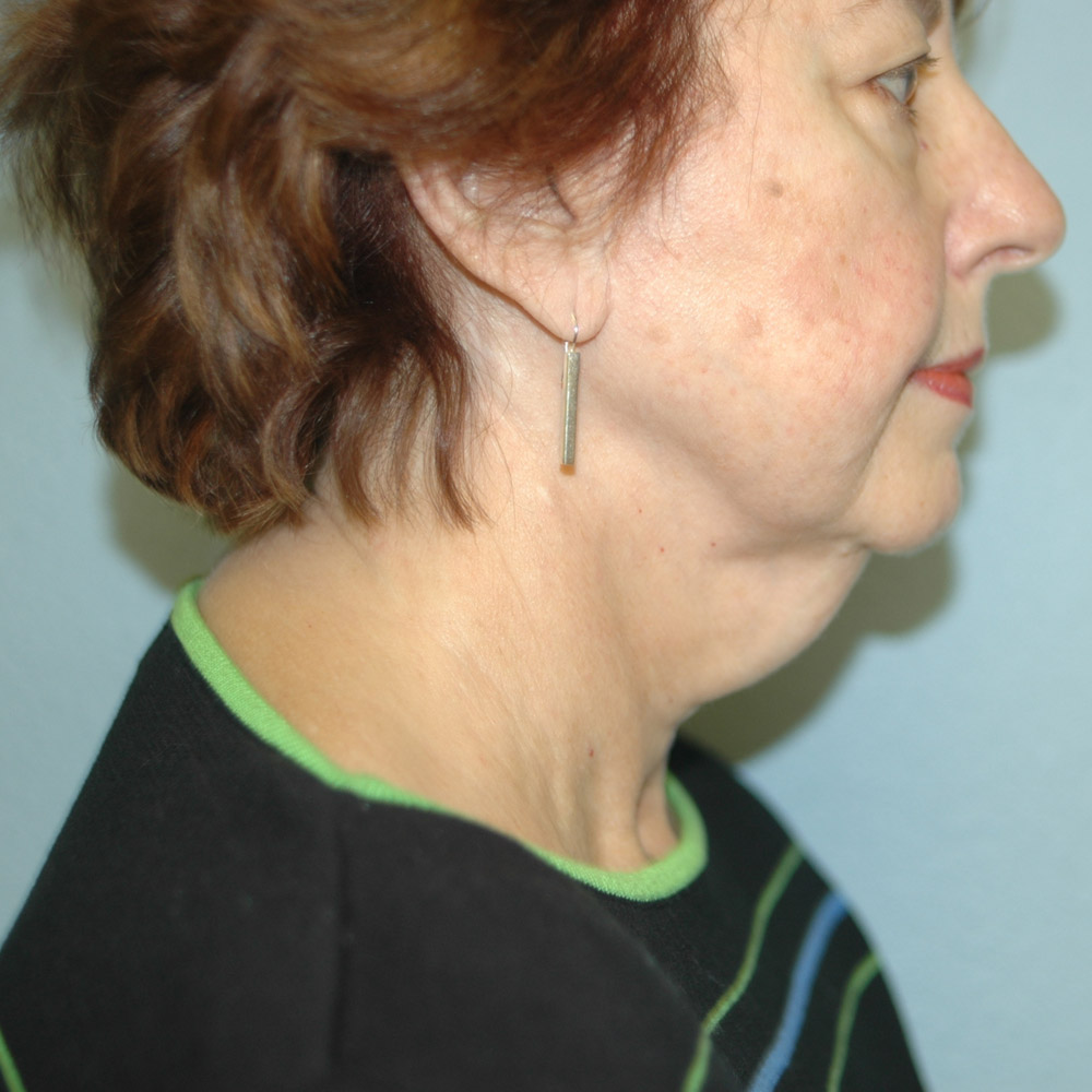 Case--8693 | Before Facelift and Neck Lift 3
