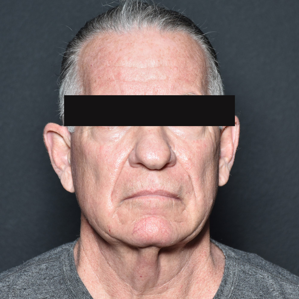 Case--9474 | Before Massive Weight Loss