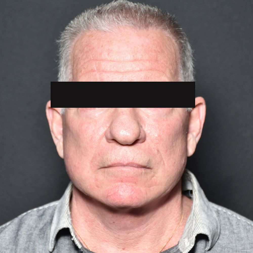 Case--9474 | After Massive Weight Loss