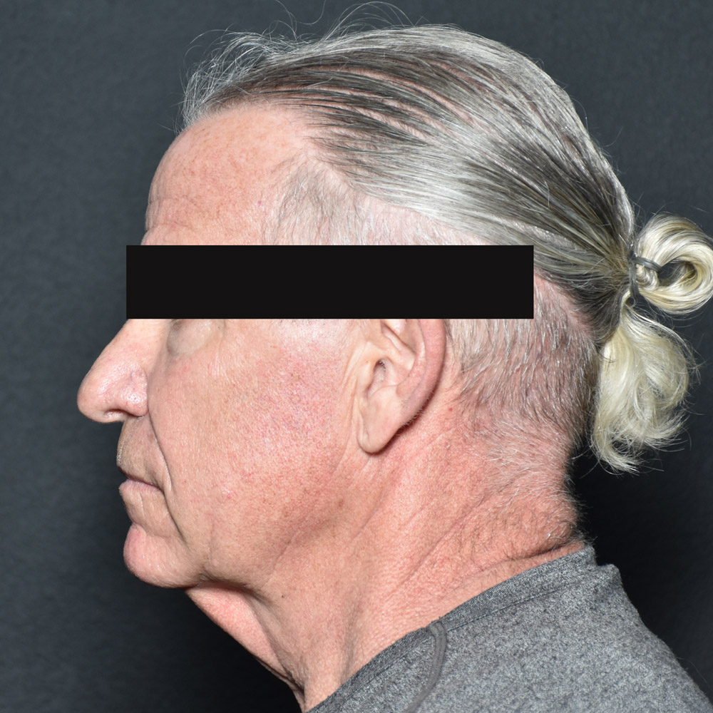 Case--8828 | Before Facelift and Neck Lift 3