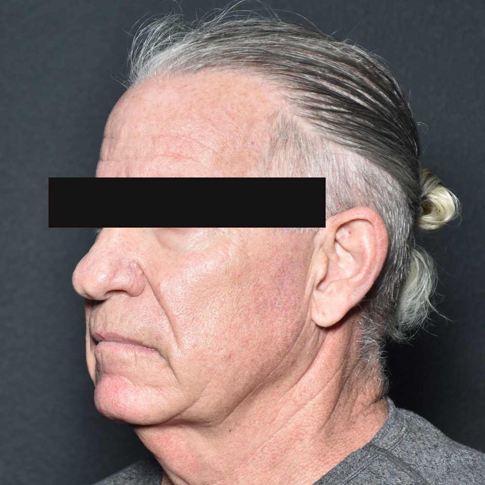 Case--8828 | Before Facelift and Neck Lift 2