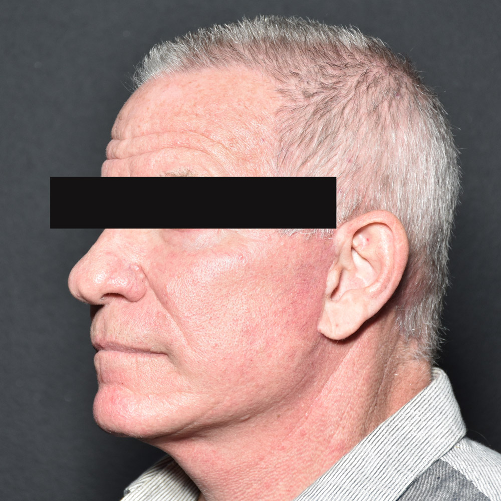 Case--8828 | After Facelift and Neck Lift 2