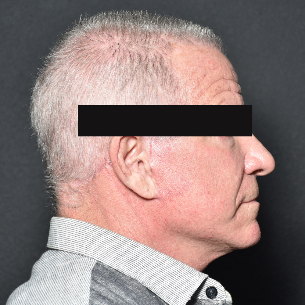 Case--8828 | After Facelift and Neck Lift 5