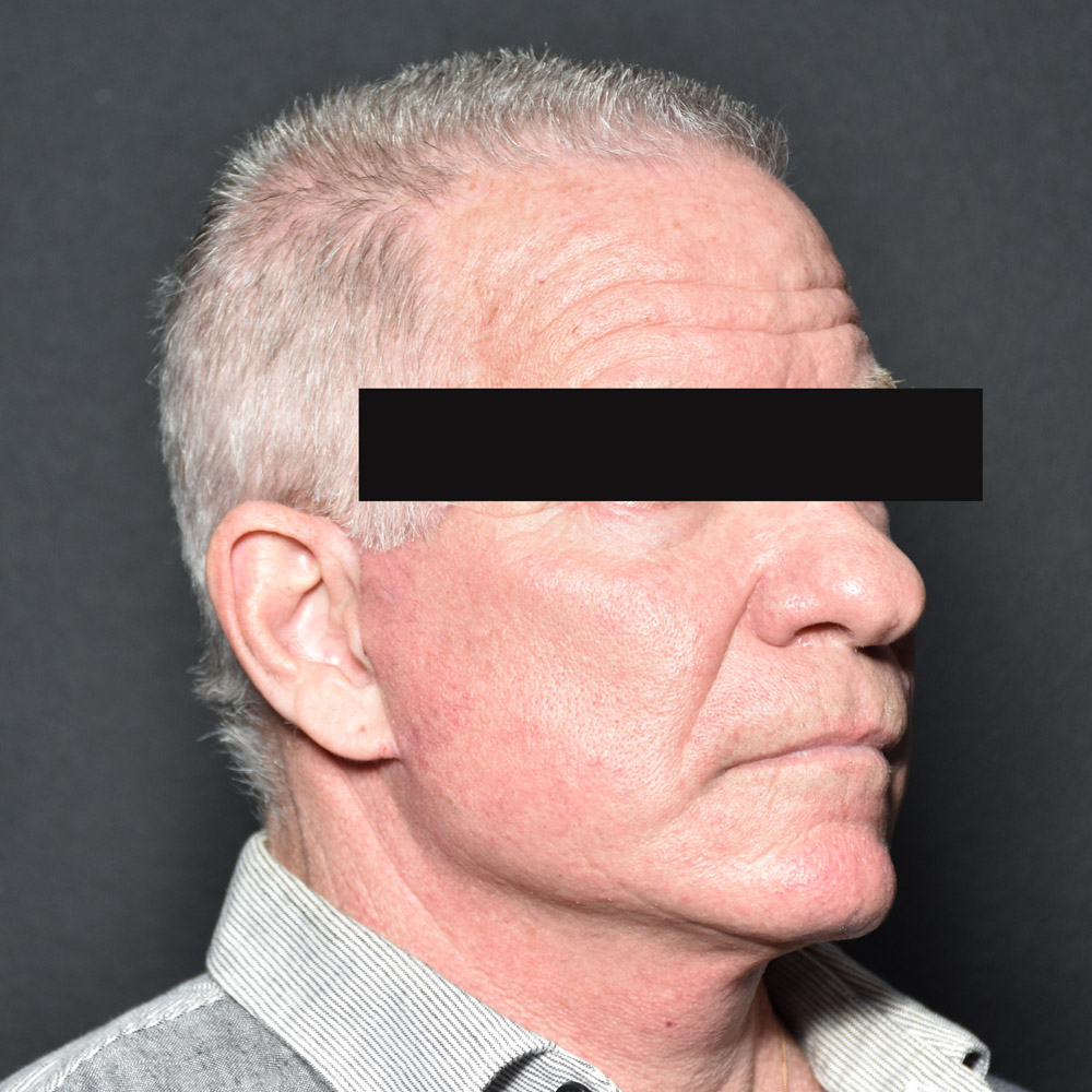 Case--8828 | After Facelift and Neck Lift 4