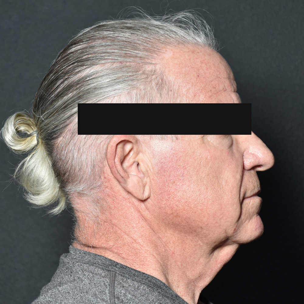 Case--8828 | Before Facelift and Neck Lift 5