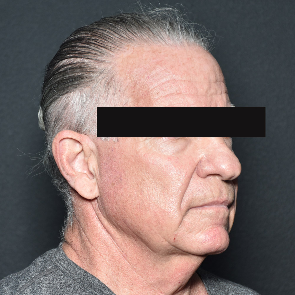 Case--8828 | Before Facelift and Neck Lift 4